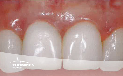 Gap Management and a CONTACT Implant in the Esthetic Zone